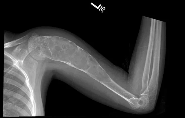 Humerus aktif basit kemik kisti.