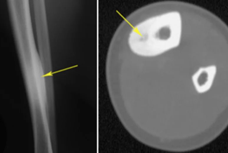 Kaval kemiğinde osteoid osteoma.