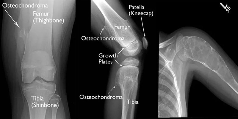 Osteokondrom